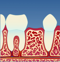 Implantat_illustrasjon_1