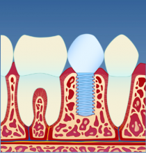 Implantat_illustrasjon_5